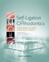 Self-Ligation in Orthodontics