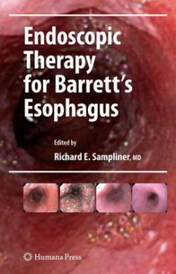 Endoscopic Therapy for Barrett´s Esophagus