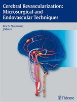 Cerebral Revascularization