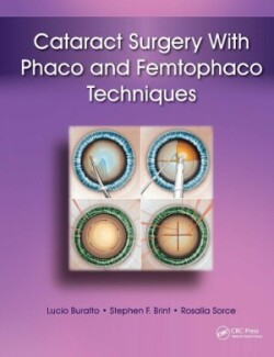 Cataract Surgery With Phaco and Femtophaco Techniques