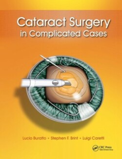 Cataract Surgery in Complicated Cases