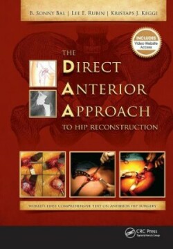 Direct Anterior Approach to Hip Reconstruction