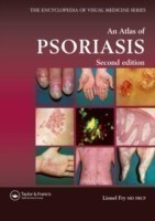 Atlas of Psoriasis, Second Edition