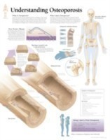 Understanding Osteoporosis Paper Poster