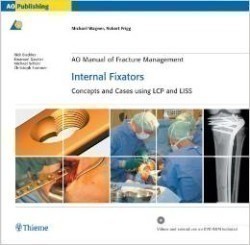 AO Manual of Fracture Management - Internal Fixators