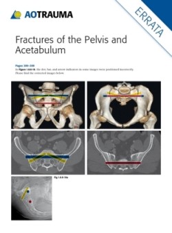 Fractures of the Pelvis and Acetabulum: Principles and Methods of Management