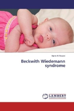 Beckwith Wiedemann syndrome