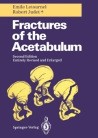 Fractures of the Acetabulum