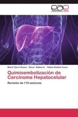 Quimioembolización de Carcinoma Hepatocelular