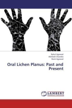 Oral Lichen Planus