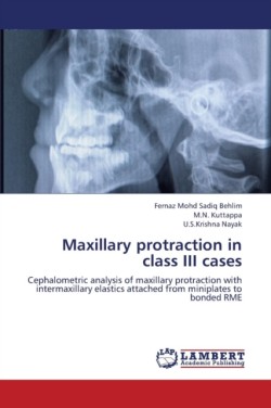 Maxillary Protraction in Class III Cases