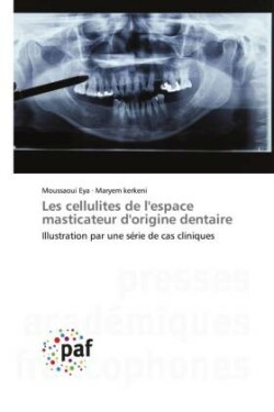 Les cellulites de l'espace masticateur d'origine dentaire