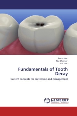 Fundamentals of Tooth Decay
