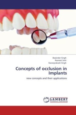 Concepts of occlusion in Implants