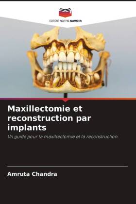 Maxillectomie et reconstruction par implants