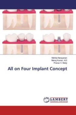 All on Four Implant Concept