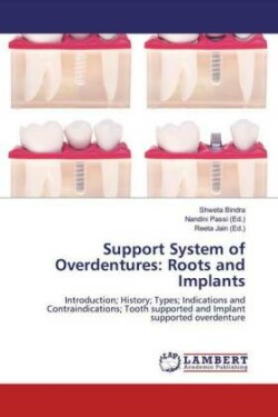 Support System of Overdentures: Roots and Implants