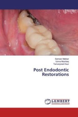 Post Endodontic Restorations