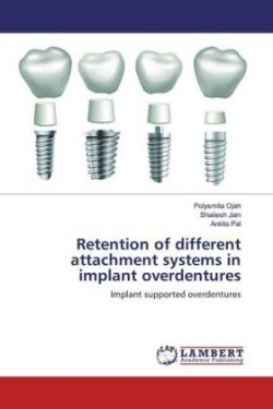 Retention of different attachment systems in implant overdentures