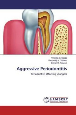 Aggressive Periodontitis