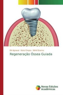 Regeneração Óssea Guiada