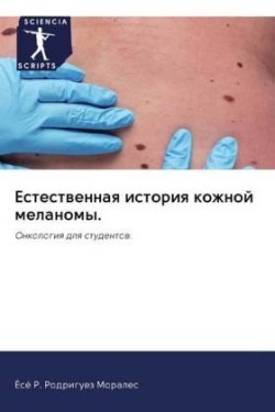 Естественная история кожной меланомы.