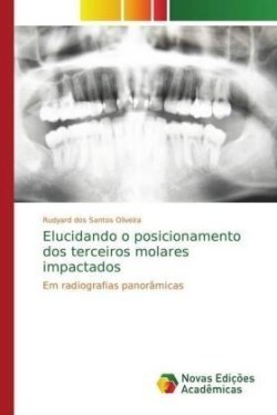 Elucidando o posicionamento dos terceiros molares impactados