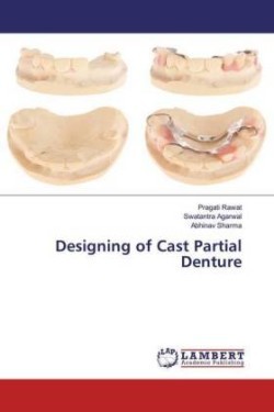 Designing of Cast Partial Denture