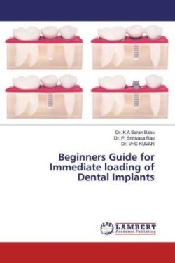 Beginners Guide for Immediate loading of Dental Implants