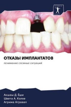 OTKAZY IMPLANTATOV