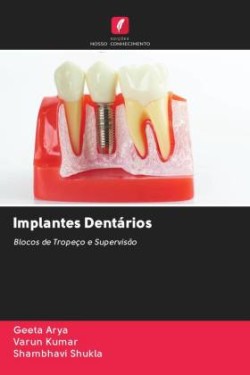 Implantes Dentários