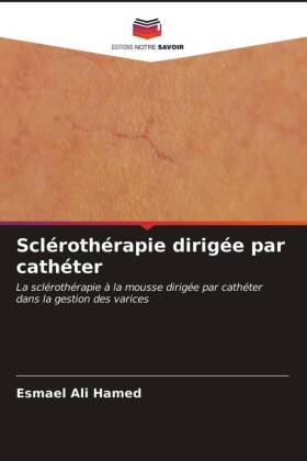 Sclérothérapie dirigée par cathéter