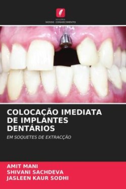 Colocação Imediata de Implantes Dentários