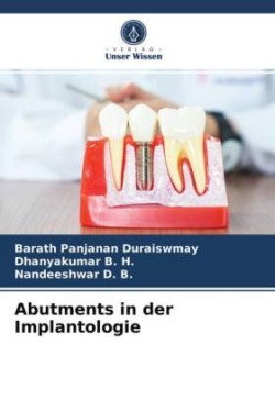 Abutments in der Implantologie