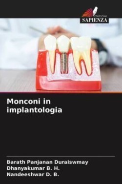 Monconi in implantologia