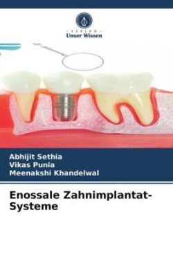 Enossale Zahnimplantat-Systeme