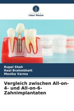 Vergleich zwischen All-on-4- und All-on-6-Zahnimplantaten