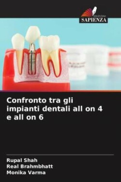 Confronto tra gli impianti dentali all on 4 e all on 6