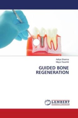 GUIDED BONE REGENERATION