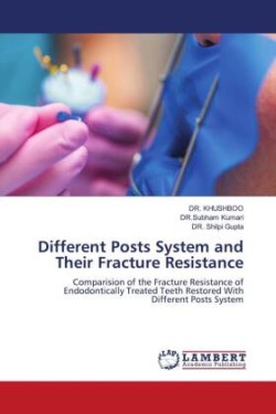 Different Posts System and Their Fracture Resistance