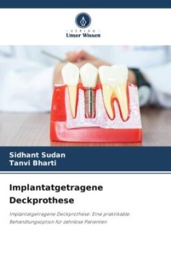 Implantatgetragene Deckprothese