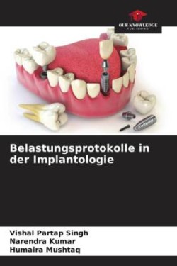 Belastungsprotokolle in der Implantologie