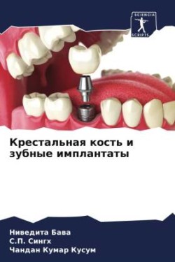 Крестальная кость и зубные имплантаты