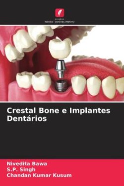 Crestal Bone e Implantes Dentários