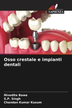 Osso crestale e impianti dentali