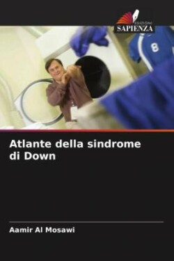 Atlante della sindrome di Down