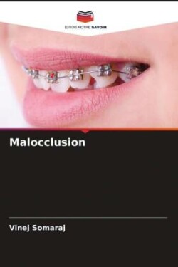 Malocclusion