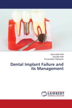 Dental Implant Failure and its Management