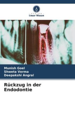 Rückzug in der Endodontie