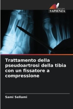 Trattamento della pseudoartrosi della tibia con un fissatore a compressione